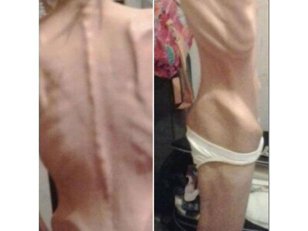 mulher anorexia 24kg