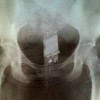 Mulher escondia celular no anus, revela exame de Raio-X celular-anus-raio-x