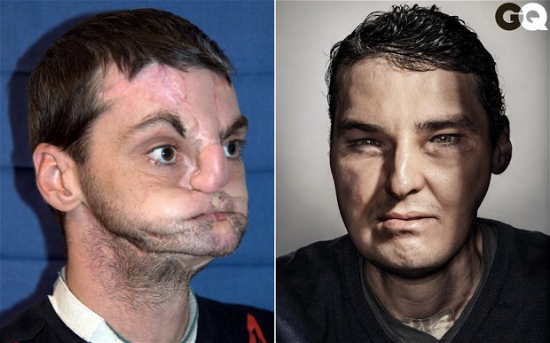 homem transplante facial rosto richard