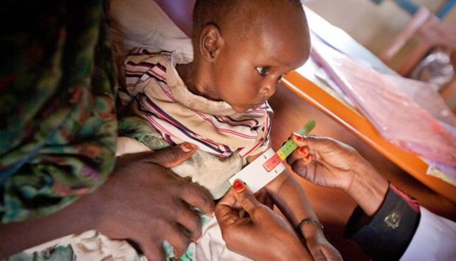 áfrica crianças têm desnutrição aguda grave 1 milhão