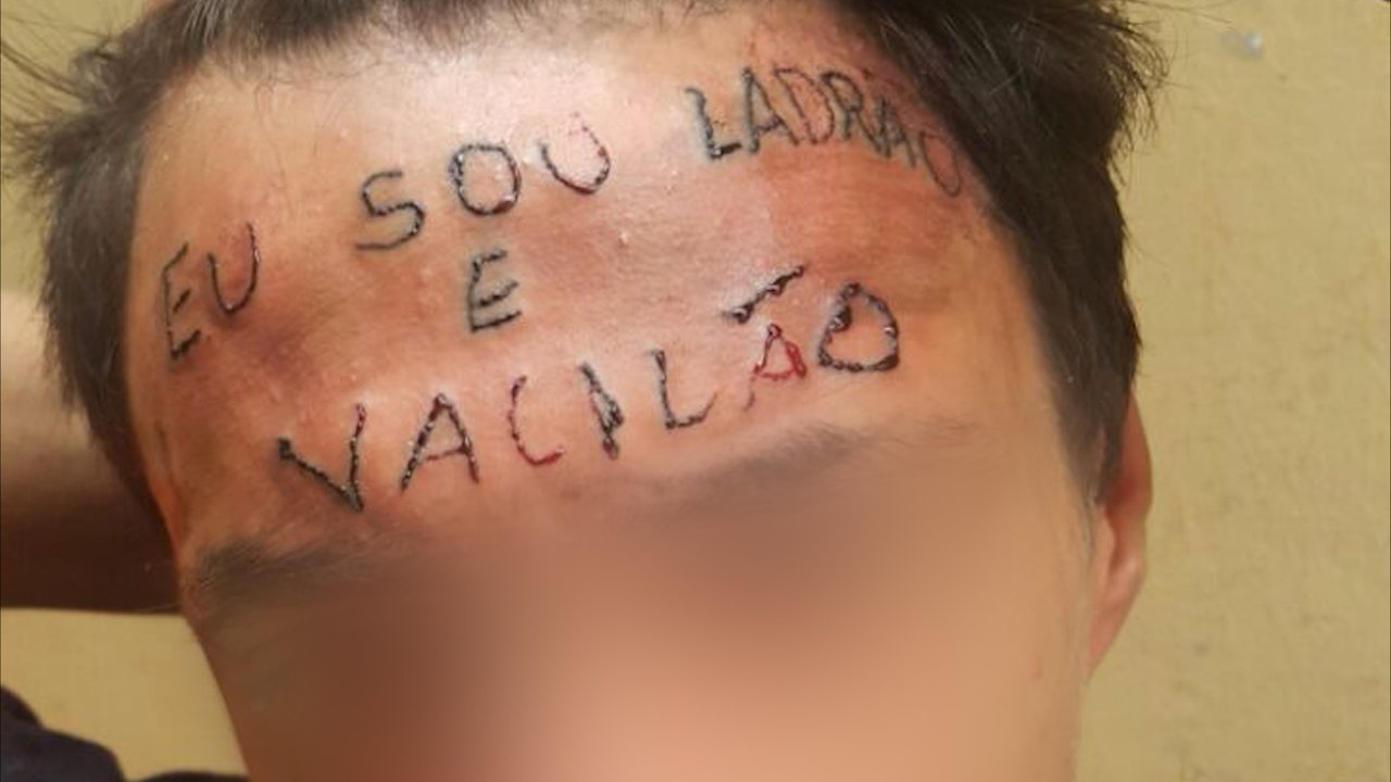 jovem remover tatuagem da testa