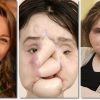 menina-suicidio-transplante-facial