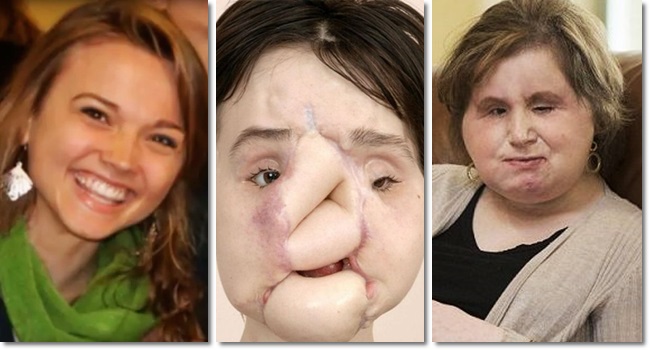Katie Stubblefield menina tentou suicídio transplante facial