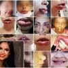 mulheres-deformadas-harmonizacao-facial-denunciam-dentista