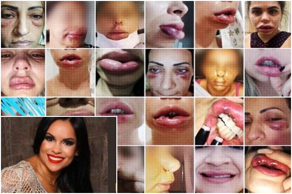 Mulheres deformadas harmonização facial denunciam dentista rio de janeiro