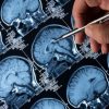 Fígado produz proteína que desencadeia Alzheimer, revela estudo figado-produz-proteina-desencadeia-alzheimer-revela-estudo