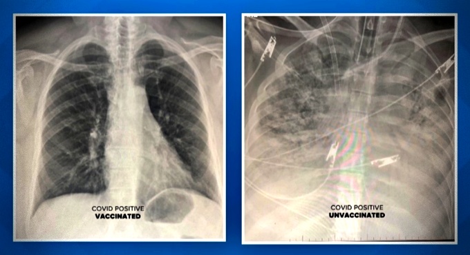 Médico mostra diferença efeito covid pulmão vacinados não vacinados