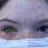 doenca-olho-verde