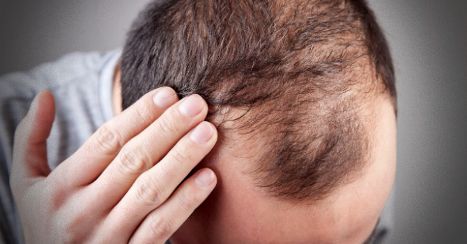 Monoxidil pode solução queda cabelo Veja sabe