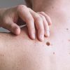 Checking benign moles. Close up detail of the bare skin on a man