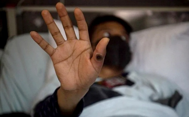 Mpox Brasil número casos sobe veja sintomas como prevenir